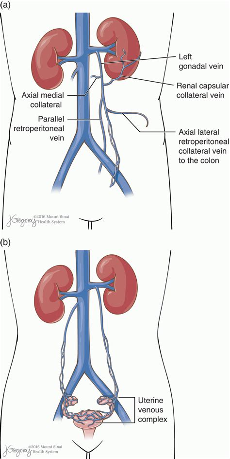 Gonadal Vein Embolization | Abdominal Key