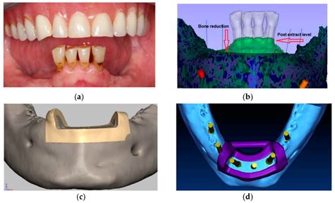 IJERPH | Free Full-Text | Variety of Surgical Guides and Protocols for ...