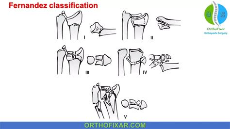 Colles Fracture Classification