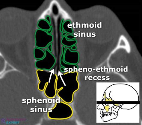 CT sinus