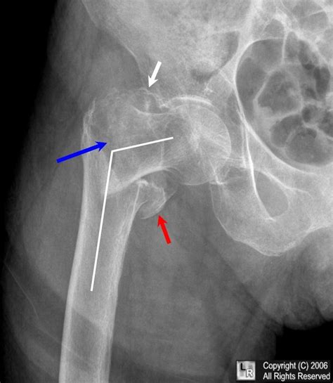 intertrochanteric hip fracture,intertrochanteric,hip fracture,hip ...