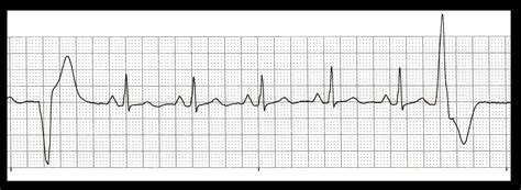 Float Nurse: Practice EKG Strips 317