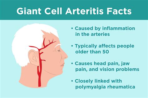 What Is Giant Cell Arteritis? Symptoms, Causes, Treatments