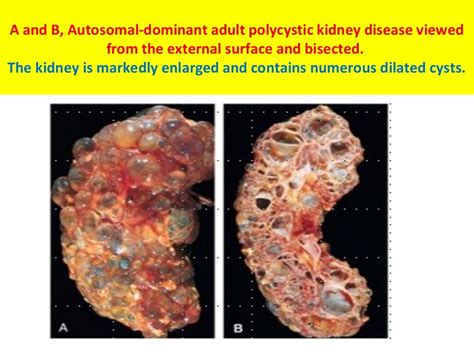 Polycystic kidney disease for students