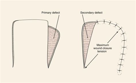 6: Flap Classification and Design | Pocket Dentistry