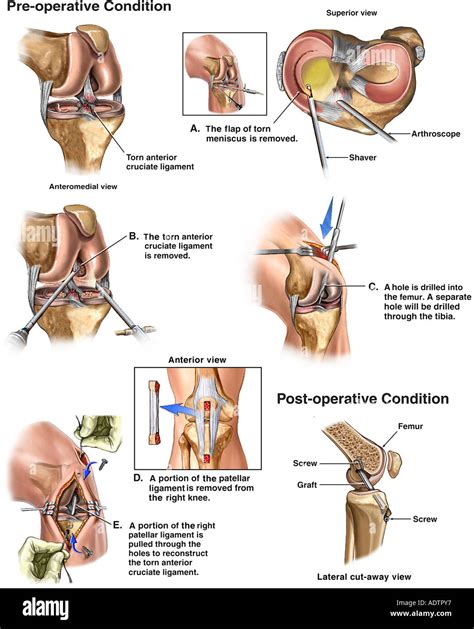 Knee Surgery - Torn Anterior Cruciate Ligament (ACL) and Medial Stock Photo: 7710006 - Alamy