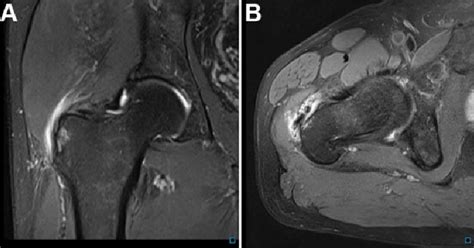 Mri Scans Of A Patient With Gluteal Tendinopathy And An Mhip Score Of 8 ...