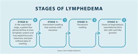 Understanding the Four Stages of Lymphedema | The Norton School Blog