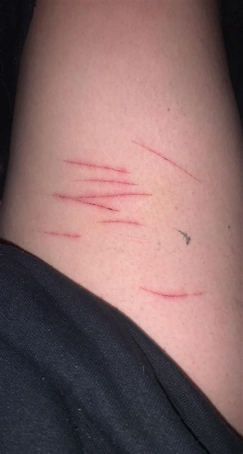 TW — WEEK OLD SH CUTS are these infected? or are they just not being treated right? i’ve been ...