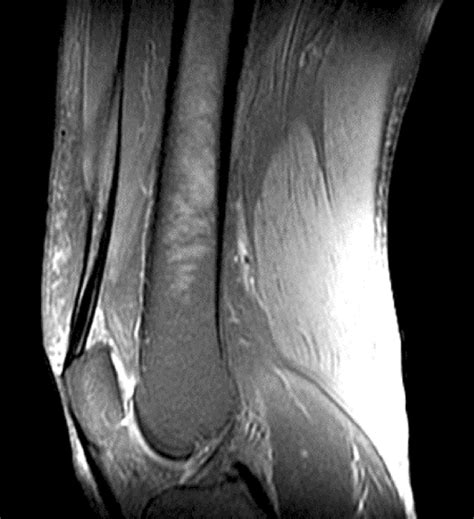 MRI of the knee, showing a diffuse hyperintense signal in the... | Download Scientific Diagram