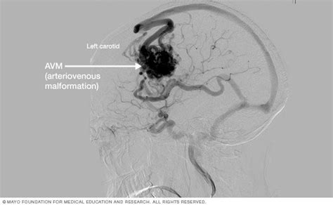 Brain AVM (arteriovenous malformation) Disease Reference Guide - Drugs.com