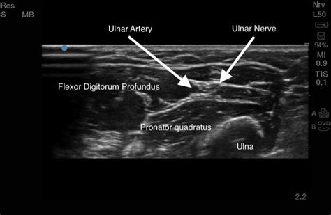 Ultrasound-guided median and ulnar nerve blocks in the forearm to facilitate onabotulinum toxin ...