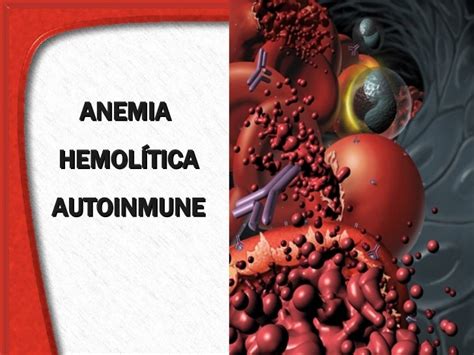 4 Anemia Hemolitica