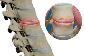 Lower Back Pain Surgery | Advanced Orthopaedics & Sports Medicine ...