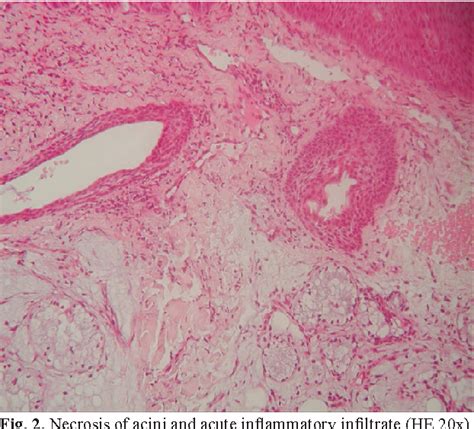 Necrotizing Sialometaplasia Histology