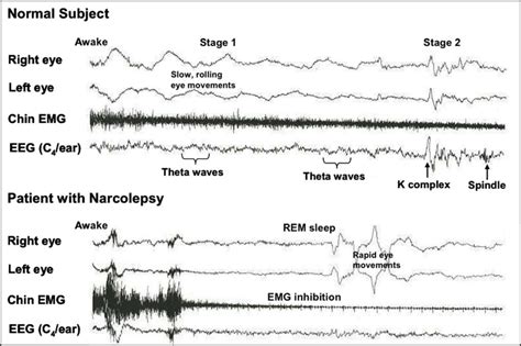 Narcolepsy - Causes, Signs, Symptoms, Medication & Treatment