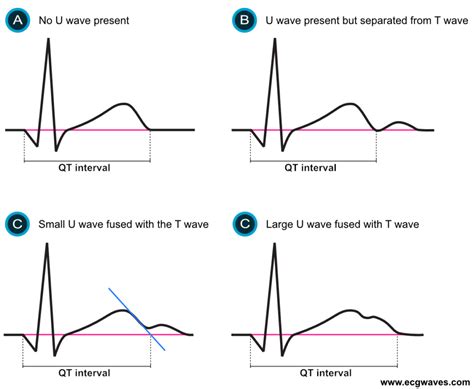 Qtcf Interval