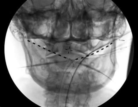 Occipital Nerve Stimulation — Matthew Mian, MD