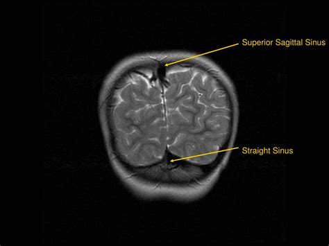 PPT - MRI of Brain/Head and Neck PowerPoint Presentation, free download ...