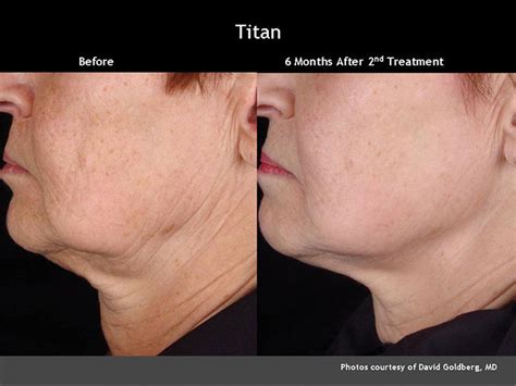 CUTERA® Titan Skin Tightening Treatment in Midtown Toronto | Midtown Med Spa Services | Midtown ...