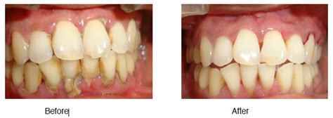 Scaling & Root Planing Treatment in Hyderabad India, FMS Dental