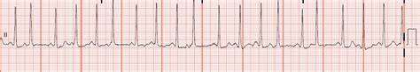 Float Nurse: EKG Rhythm Strips 36