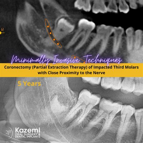 Coronectomy / Partial Extraction Therapy of Impacted Wisdom Teeth Close ...