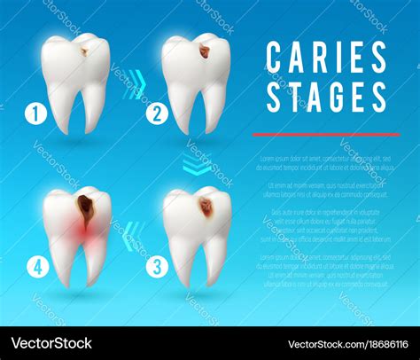 Tooth decay 3d poster of dental caries development