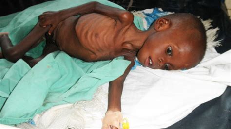 Malnutrition in children on the rise in Iganga - Daily Monitor