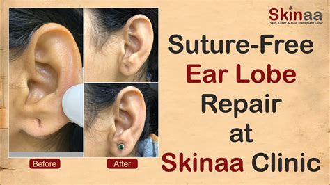 Suture-Free Ear Lobe Repair at Skinaa Clinic | Advanced Stitch-Less Ear ...