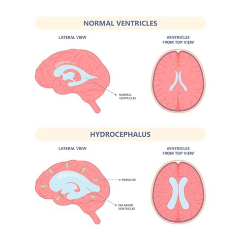 Cerebrospinal Fluid Disorders | CSF Leak