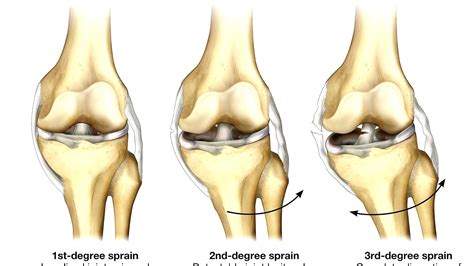 Fibular collateral ligament Injury - Injury Choices