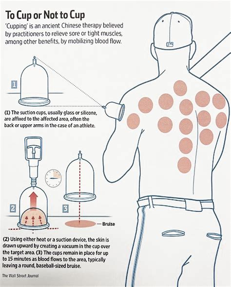 Cupping Therapy - Toronto Reflexology