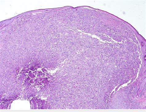 The image is showing spindle cell carcinoma, small islands and, cords ...