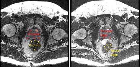 Side Effects Of External Beam Radiation Prostate Cancer - The Best Picture Of Beam