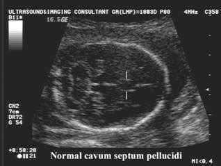 Cavum Septum Pellucidum Diagram