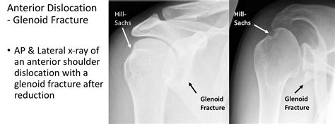 Fig 14. Traumatic Anterior Dislocation - x-ray of the same shoulder ...