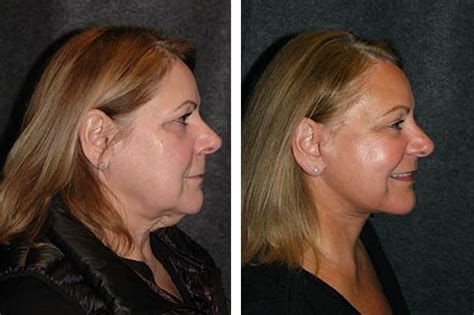 Lower Facelift New York | Lower Facelift and Necklift