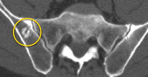 Bone Island (Enostosis): Symptoms, Causes & Treatment