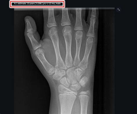 Calculating Bone Age Using X-rays [Includes AI-based Automated Tools ...