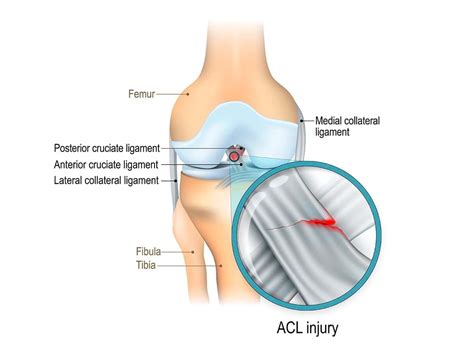 Dr Terence Moopanar | ACL rupture