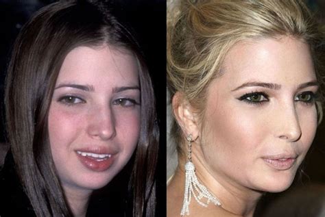 Hollywood Plastic Surgery Disasters - Inspiring Your Life