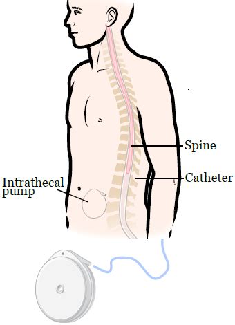 About Your Intrathecal Pump (2022)