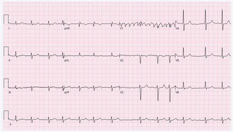 File:Afib V1.png - ECGpedia