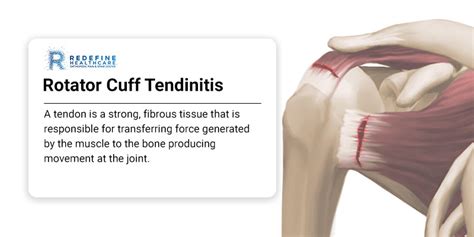 Rotator Cuff Tendinopathy Definition Symptoms Causes Melbourne | The Best Porn Website