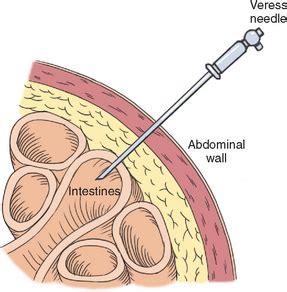 Laparoscopic Surgery | Basicmedical Key