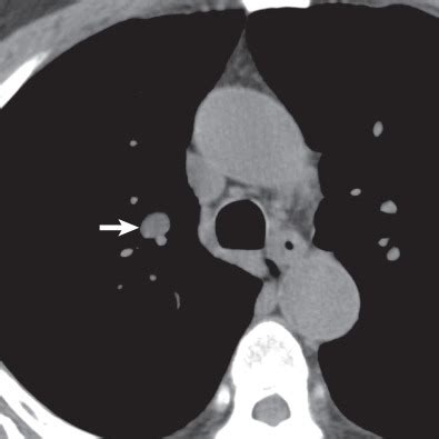 Pulmonary Hamartoma | Radiology Key