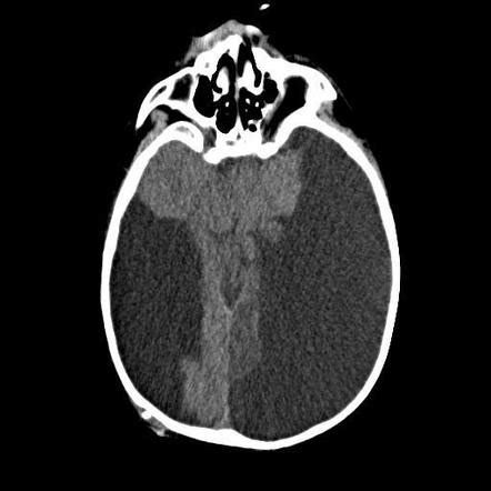 Hydranencephaly | Radiology Case | Radiopaedia.org