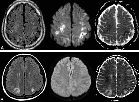 Cytotoxic Edema in Posterior Reversible Encephalopathy Syndrome: Correlation of MRI Features ...