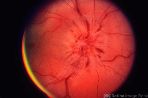 Papillitis - Retina Image Bank